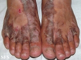 inflammatory linear verrucous epidermal naevi-bilateral