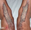 inflammatory linear verrucous epidermal naevi-bilateral
