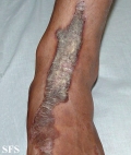 inflammatory linear verrucous epidermal naevi-bilateral