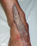 inflammatory linear verrucous epidermal naevi-bilateral