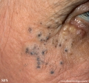 favre-racouchot syndrome