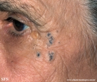 favre-racouchot syndrome