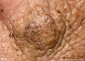 favre-racouchot syndrome