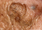 favre-racouchot syndrome
