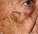 favre-racouchot syndrome