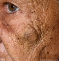 favre-racouchot syndrome