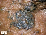 favre-racouchot syndrome
