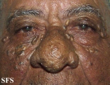 favre-racouchot syndrome