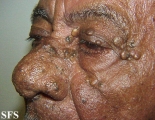 favre-racouchot syndrome