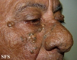 favre-racouchot syndrome