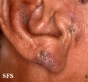 favre-racouchot syndrome