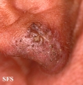 favre-racouchot syndrome