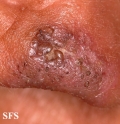 favre-racouchot syndrome
