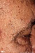 favre-racouchot syndrome