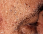 favre-racouchot syndrome