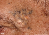 favre-racouchot syndrome