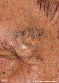 favre-racouchot syndrome