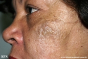 favre-racouchot syndrome