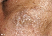 favre-racouchot syndrome