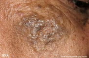 favre-racouchot syndrome