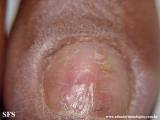 glomus tumor