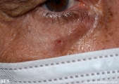 basaloid_follicular_hamartoma-ulcerated_basaloid_follicular_hamartoma
