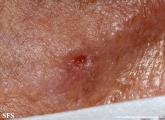 basaloid_follicular_hamartoma-ulcerated_basaloid_follicular_hamartoma