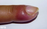pyogenic paronychia