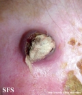 amelanotic lentigo maligna and melanoma