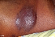 kaposi's sarcoma