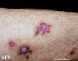 kaposi's sarcoma