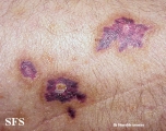 kaposi's sarcoma