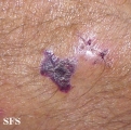 kaposi's sarcoma