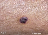kaposi's sarcoma