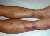 kaposi's sarcoma