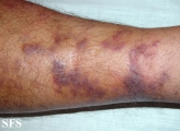 kaposi's sarcoma