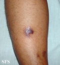 kaposi's sarcoma