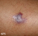kaposi's sarcoma