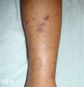 kaposi's sarcoma