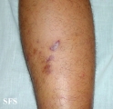 kaposi's sarcoma