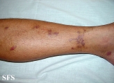 kaposi's sarcoma