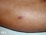kaposi's sarcoma
