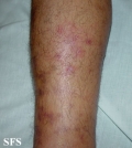 kaposi's sarcoma