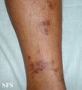 kaposi's sarcoma