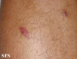 kaposi's sarcoma