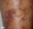 kaposi's sarcoma