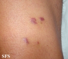 kaposi's sarcoma