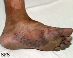 kaposi's sarcoma