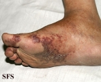 kaposi's sarcoma