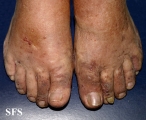 kaposi's sarcoma